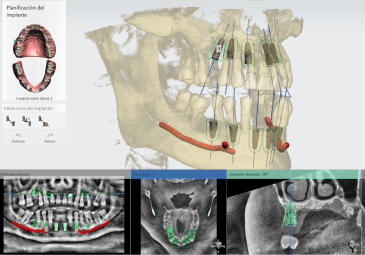 previaimplantcenter-dental-implant-clinic-in-tijuana-digital-planning
