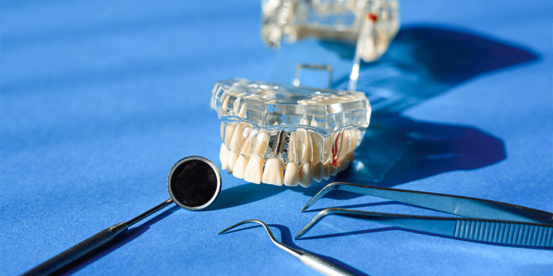 advantages-of-dental-implants-over-dentures-or-a-bridge