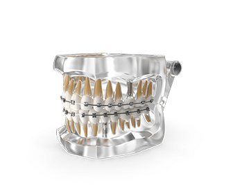 can-you-get-braces-with-dental-implants-previa-implant-center