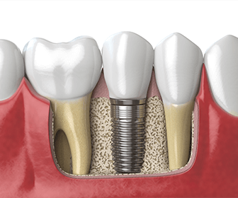 the-four-best-teeth-replacement-options-and-which-one-is-for-you