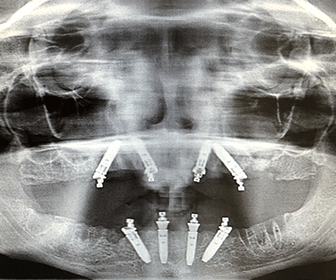all-on-4-dental-implants-in-tijuana-mexico