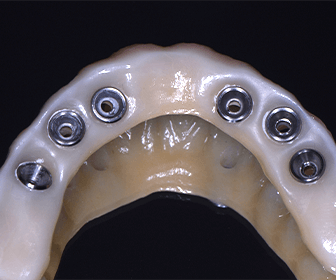 all-on-6-dental-implants-procedure-at-previa-implant-center-tijuana