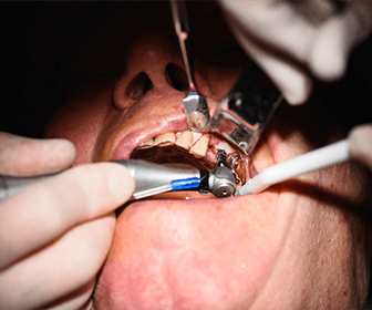 dental-implant-procedure-steps