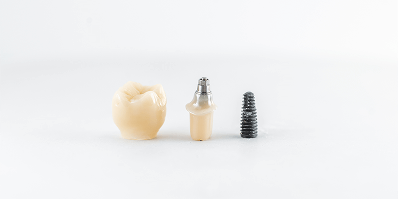 what-is-dental-implant-reconstruction-do-you-need-it