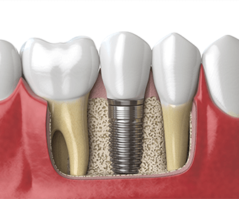 lisp-after-dental-implants-how-low-long-does-it-last