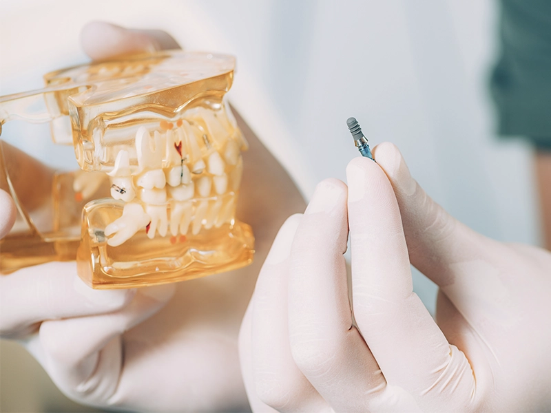 how-does-smile-design-for-dental-implants-work-3-scenarios-previa-implant-center-tijuana