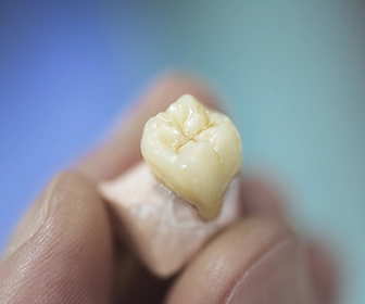 porcelain-crowns-are-often-used-in-dental-implant-patients-when-the-tooth-being-replaced-is-severely-damaged-implants-previa-implant-center-tijuana